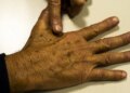cancer-de-pele:-com-a-chegada-do-verao,-prevencao-e-fundamental-para-evitar-a-doenca