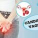 candidiase-vaginal:-o-que-e,-sintomas,-diagnostico,-tratamento-e-prevencao