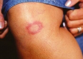 hanseniase:-conheca-verdades-e-mitos-sobre-a-doenca