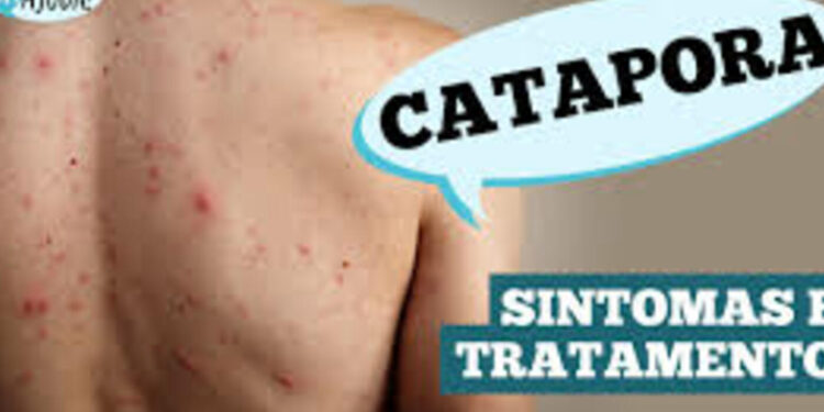 dr.-ajuda:-qual-a-relacao-da-catapora-com-o-herpes-zoster?