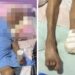Enfermeira amputa pé de idosa de 103 anos sem anestesia no DF; caso é investigado