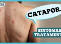 catapora:-sintomas,-complicacoes-e-prevencao