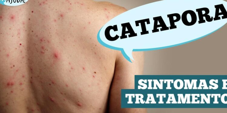 catapora:-sintomas,-complicacoes-e-prevencao