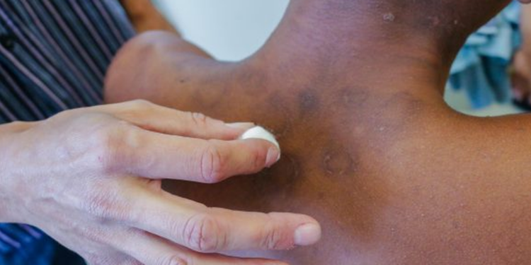 ia-criada-por-brasileiros-avalia-risco-de-agravamento-da-hanseniase