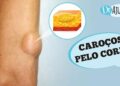 carocos-pelo-corpo-e-lipoma:-o-que-sao?-o-que-reparar?