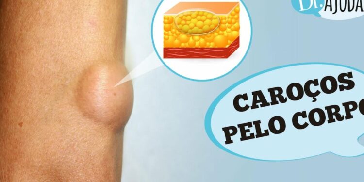 carocos-pelo-corpo-e-lipoma:-o-que-sao?-o-que-reparar?