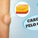 carocos-pelo-corpo-e-lipoma:-o-que-sao?-o-que-reparar?