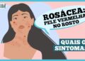 rosacea:-o-que-e-e-quais-sao-os-sintomas