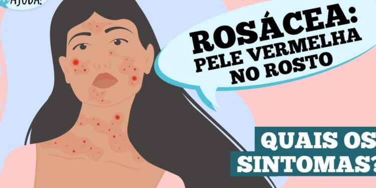 rosacea:-o-que-e-e-quais-sao-os-sintomas