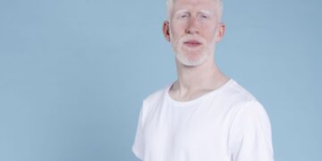 sancionada-lei-que-cria-politica-de-protecao-a-pessoas-com-albinismo