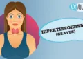hipertireoidismo,-o-que-e?
