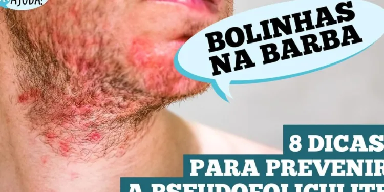 pseudofoliculite:-saiba-como-prevenir