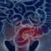 estudo-projeta-aumento-de-36%-em-mortes-por-cancer-colorretal-ate-2040