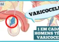 varicocele:-o-que-e-importante-saber?