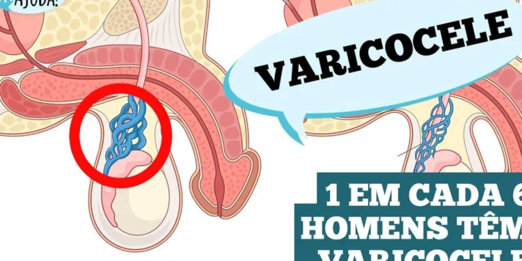 varicocele:-o-que-e-importante-saber?
