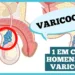 varicocele:-o-que-e-importante-saber?