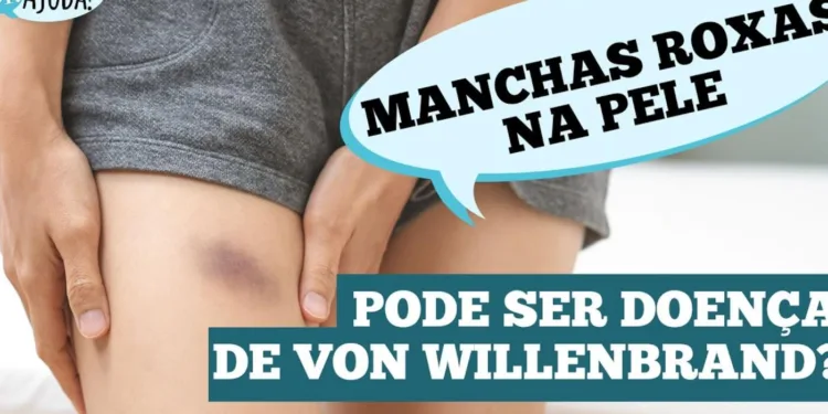 doenca-de-von-willebrand:-o-que-e-e-como-cuidar