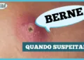 berne:-parece-uma-espinha,-mas-pode-ser-uma-larva-na-pele