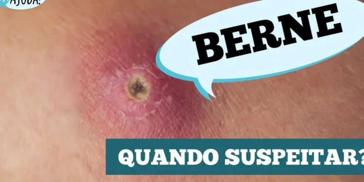 berne:-parece-uma-espinha,-mas-pode-ser-uma-larva-na-pele