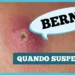 berne:-parece-uma-espinha,-mas-pode-ser-uma-larva-na-pele