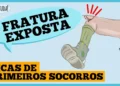 fratura-exposta:-dicas-de-primeiros-socorros