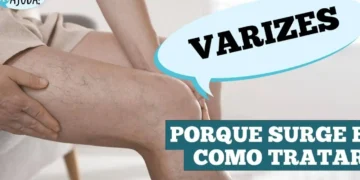 varizes:-nao-e-so-estetica-e-saude-vascular