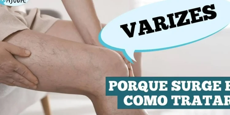 varizes:-nao-e-so-estetica-e-saude-vascular