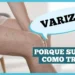 varizes:-nao-e-so-estetica-e-saude-vascular