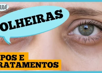 olheiras:-por-que-aparecem-e-o-que-fazer