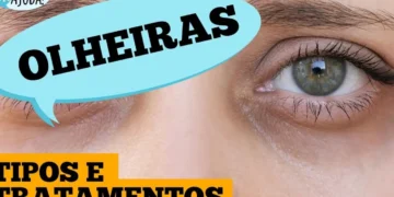 olheiras:-por-que-aparecem-e-o-que-fazer