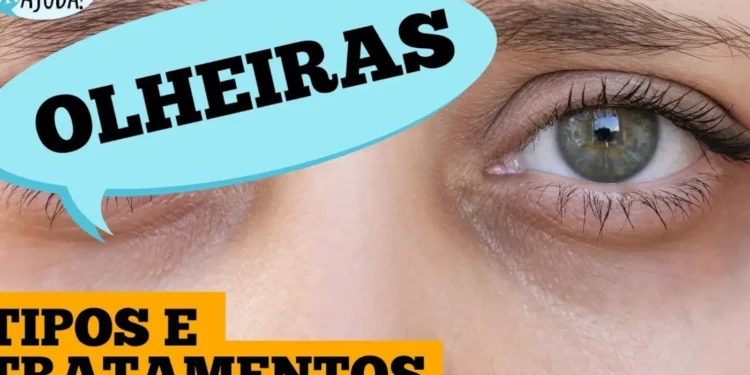 olheiras:-por-que-aparecem-e-o-que-fazer