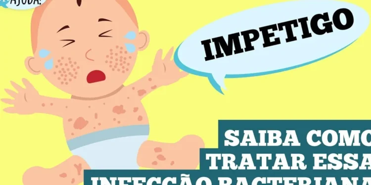 impetigo:-a-infeccao-de-pele-comum-em-criancas!-saiba-como-tratar
