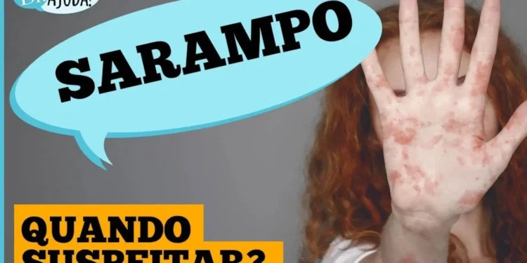 sarampo:-quando-suspeitar